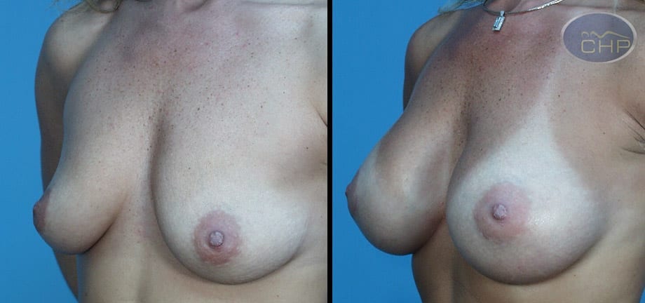 Image: Suture Suspension Breast Lift Before and After photos (group 2) at Centers for Health Promotion in Florida