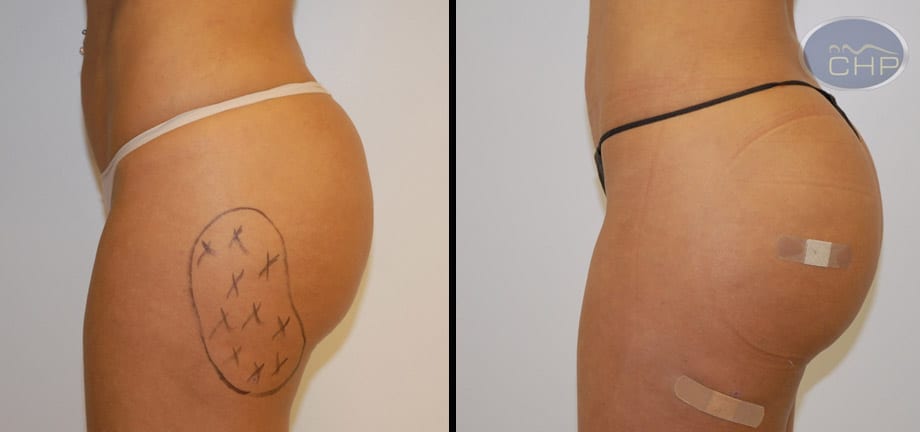 Image: Suture Suspension Butt Lift Before and After photos (group 1) at Centers for Health Promotion in Florida