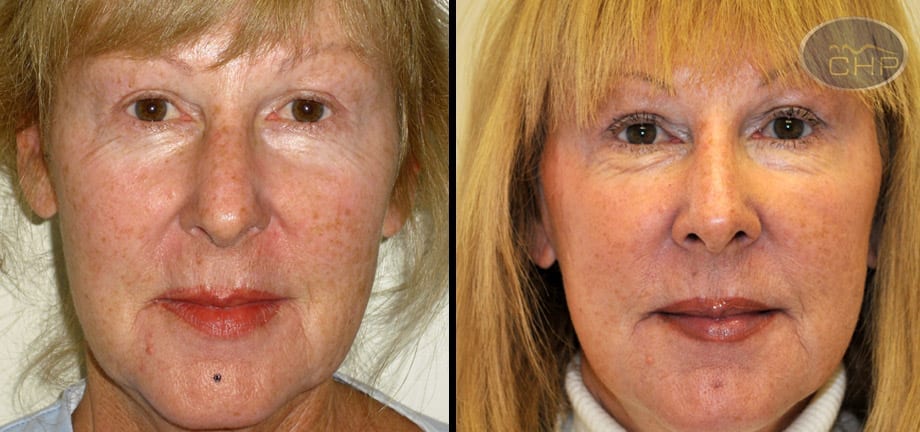 Image: Suture Suspension Face Lift Before and After photos (group 1) at Centers for Health Promotion in Florida