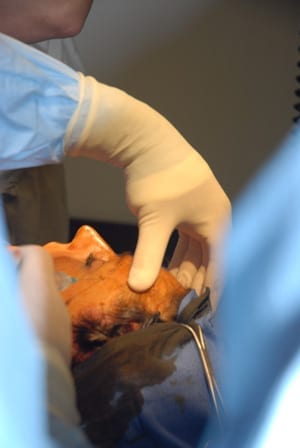 Dr. Reynolds prepares for a suture suspension lift during a preceptorship.