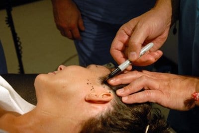 dr.-serdev-marking-patient-for-face-lift