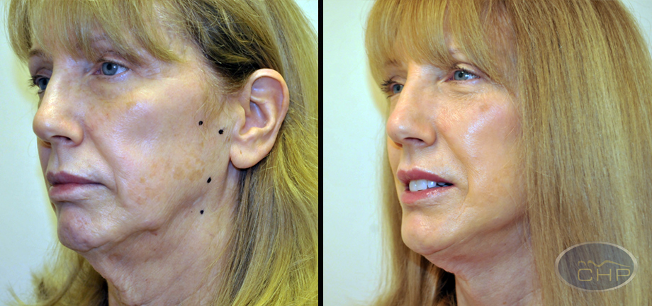 suture-suspension-face-lift-left-oblique-before-and-10-days-after.bak