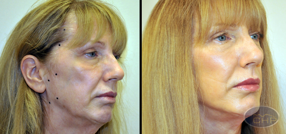 suture-suspension-face-lift-right-oblique-before-and-10-days-after.bak