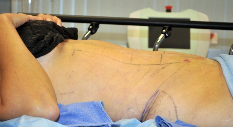 Ultra-High definition liposuction patient with markings waits on stretcher bed in OR.