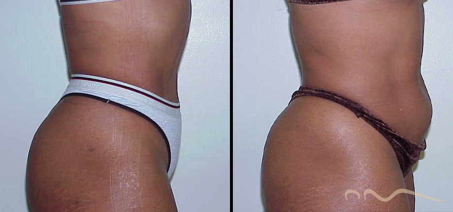 lipo-before-after-2025-01