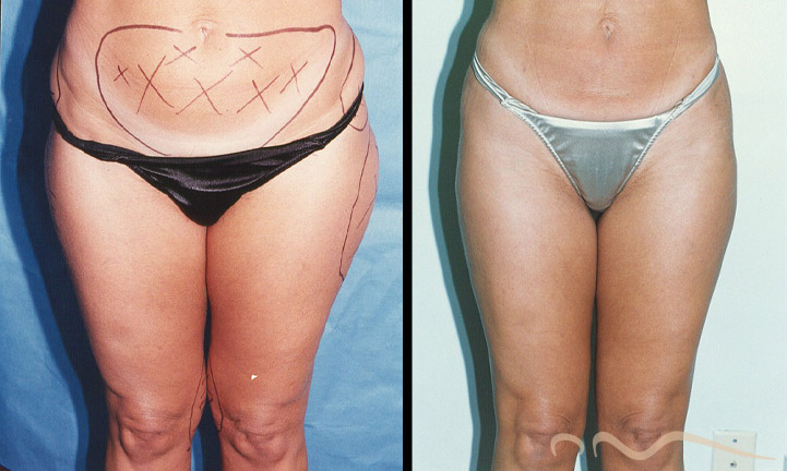 lipo-before-after-2025-02