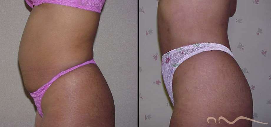 lipo-before-after-2025-03